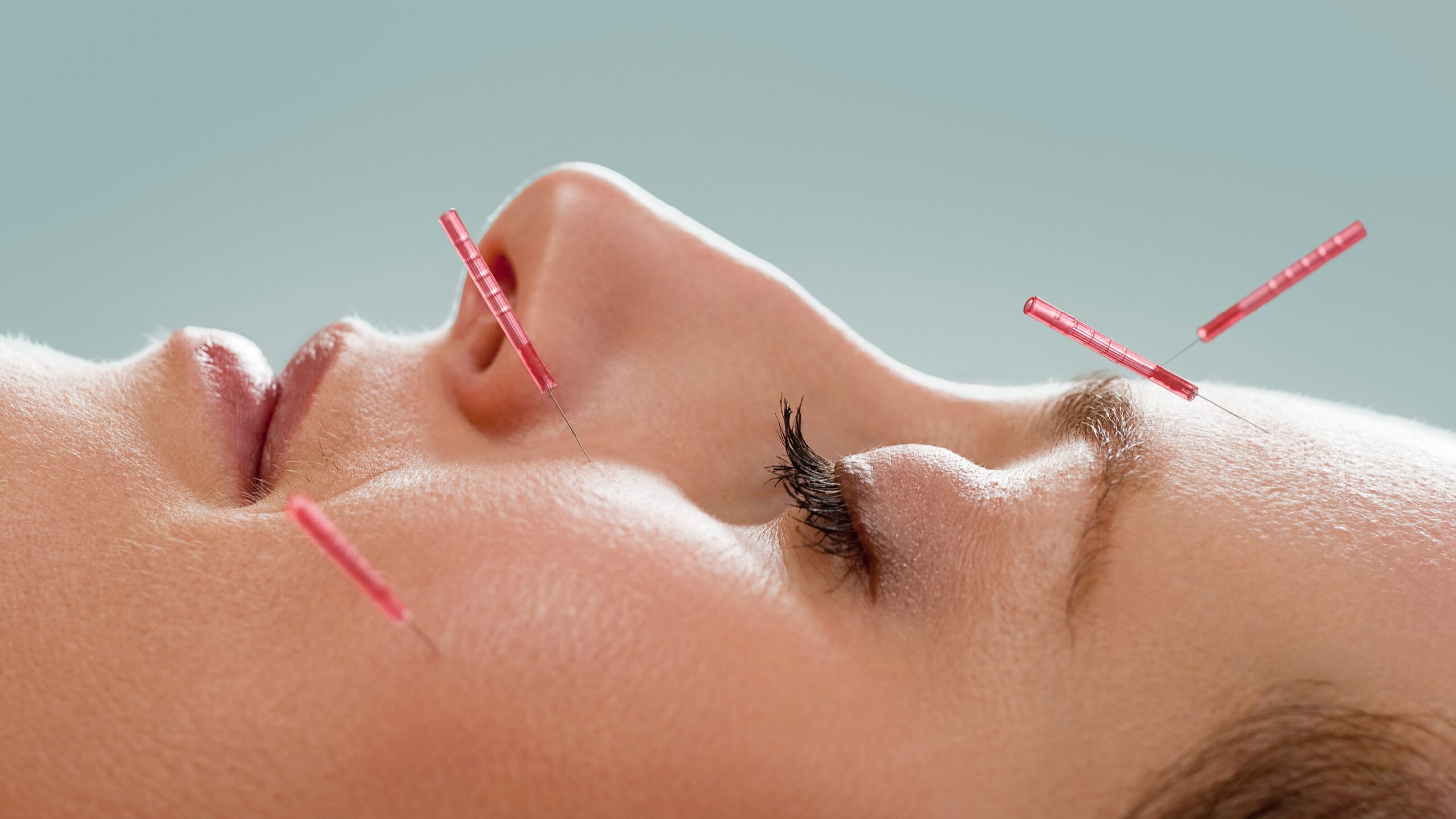 Close up of woman's face receiving facial acupuncture treatment with .5mm Seirin red acupuncture needles.