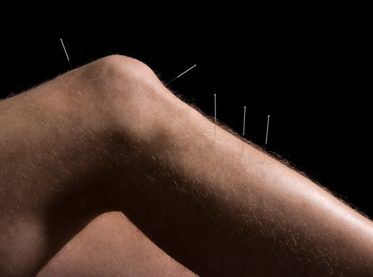 A man's knee and leg with acupuncture needles.