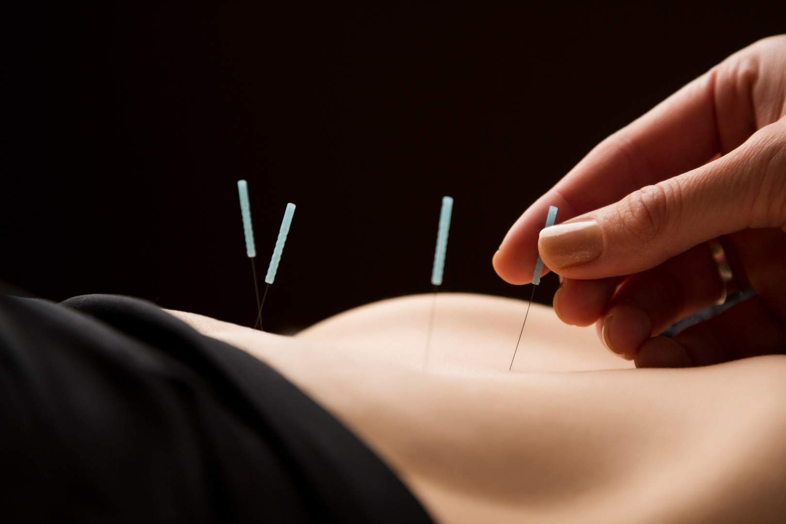 Acupuncture being performed on lower back.